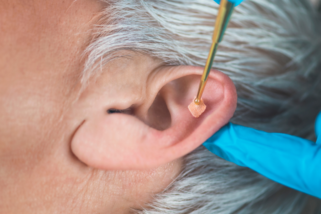 Auricular acupuncture ear seeds supporting treatment beyond the clinic